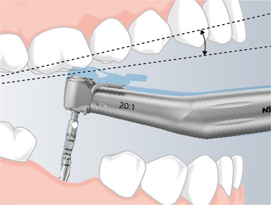 A more compact yet powerful motor  and minimized handpiece head reduce strain.